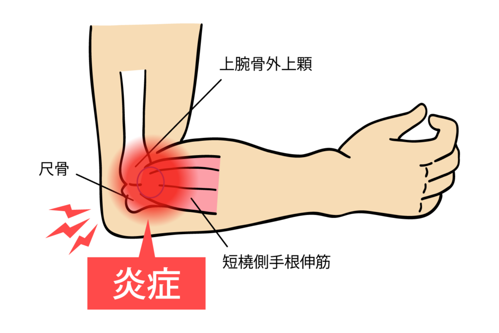 hanaike-tennis-elbow_img02