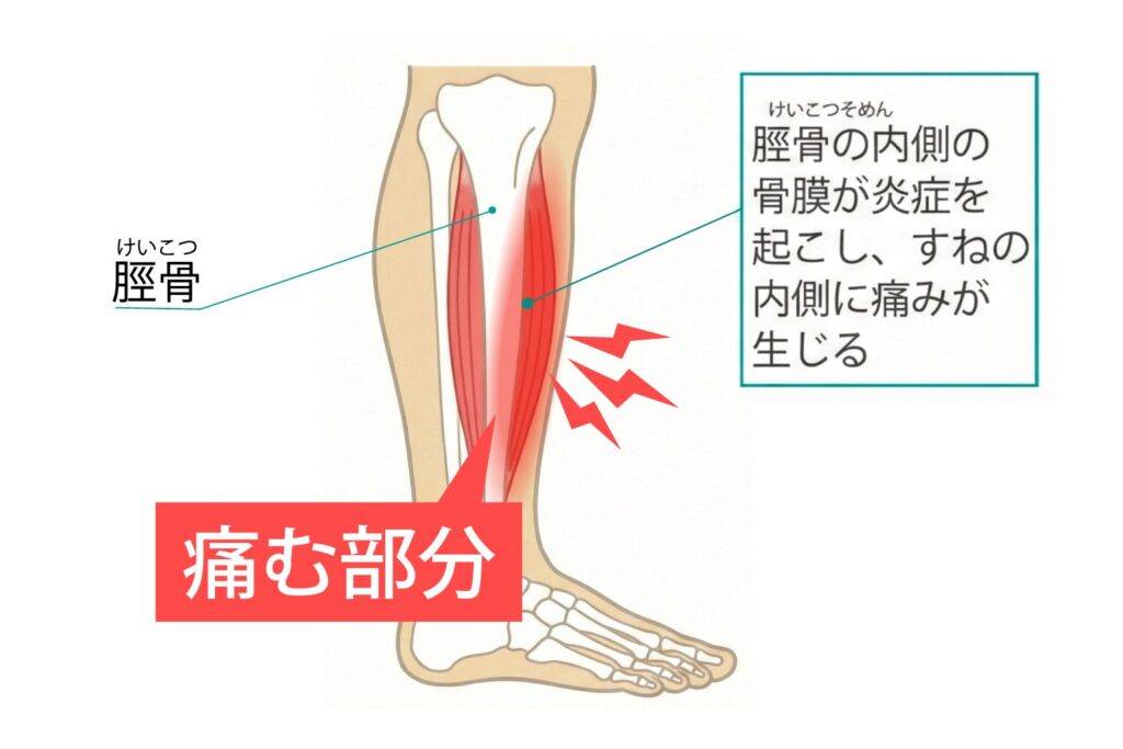 hanaike-shin-splints_img02