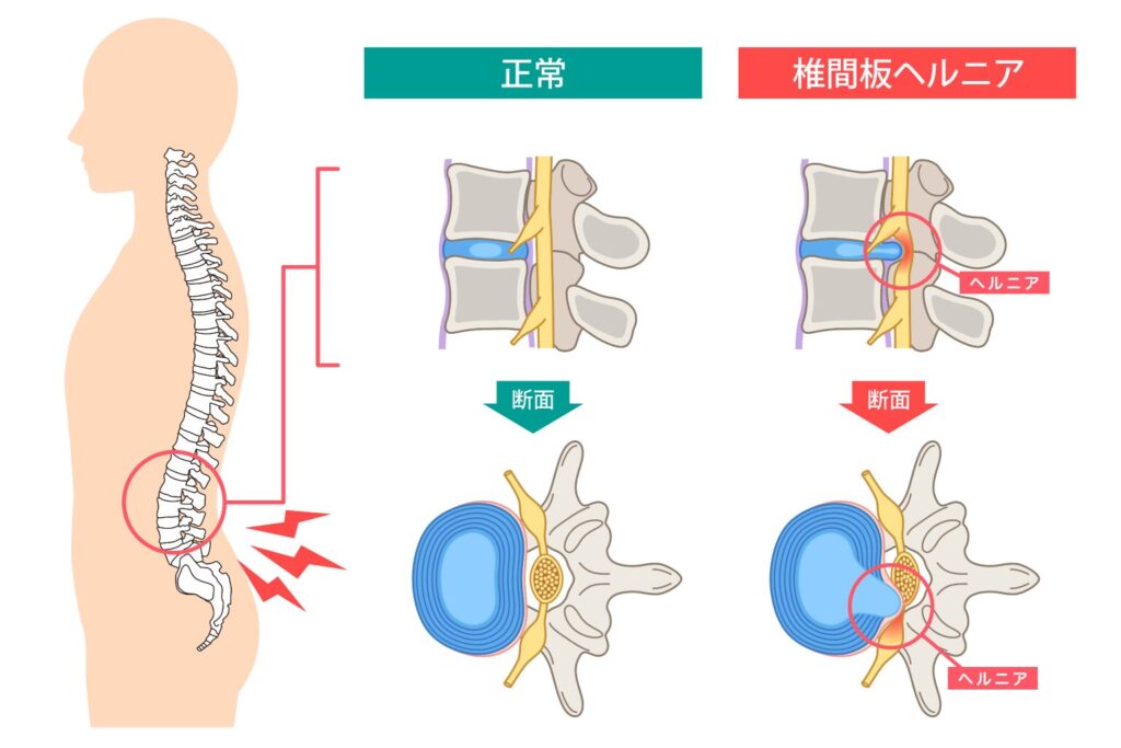 hanaike-hernia_img